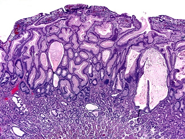 Portal Gastropathy and Bleeding Polyps in Cirrhosis